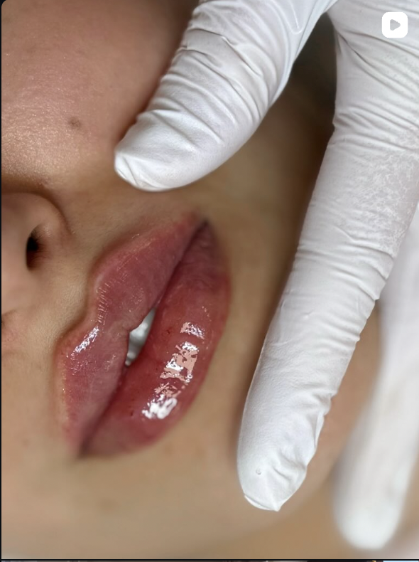 Filler behandeling — lippen en volume