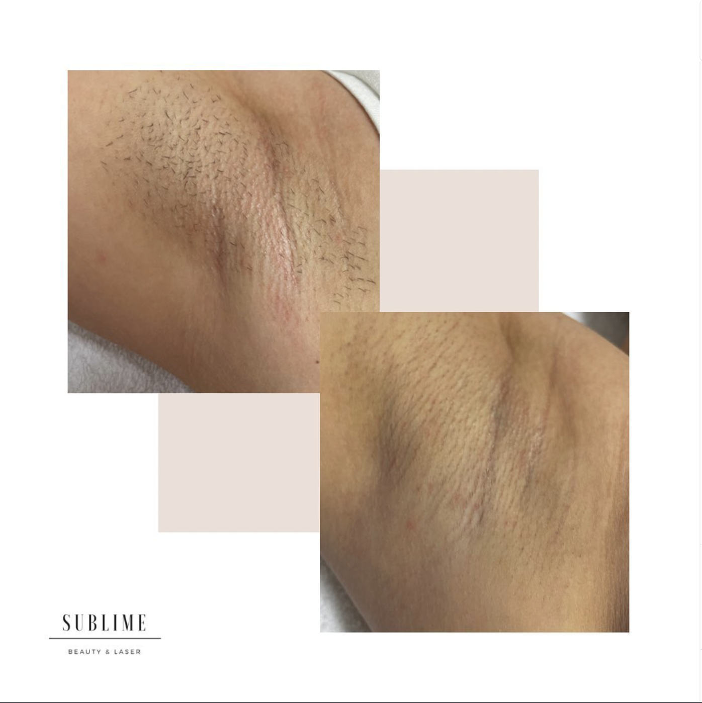Oksels — voor en na laserontharing