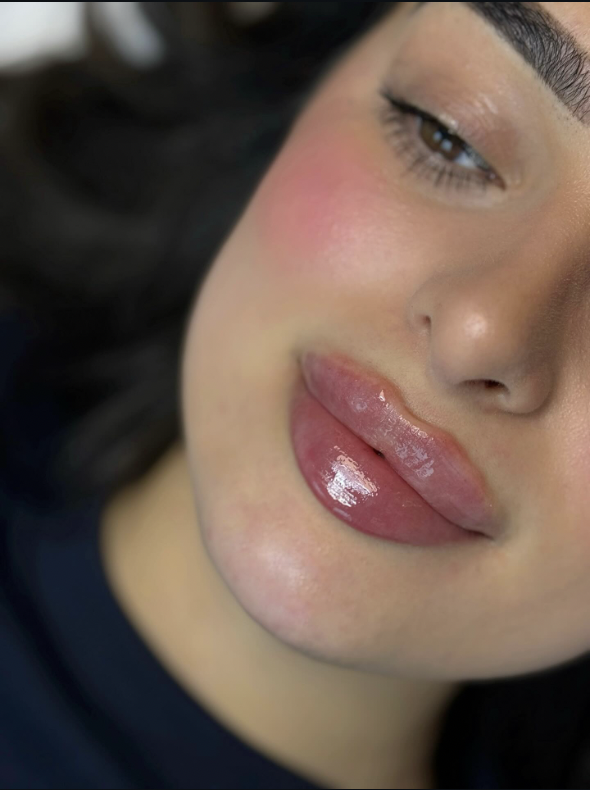 Natuurlijk lipfiller resultaat